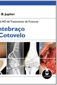 Livro Manual AO de Tratamento de Fraturas. Antebraço e Cotovelo - Resumo, Resenha, PDF, etc.